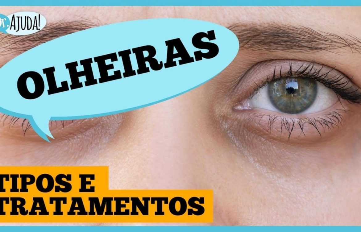 olheiras:-por-que-aparecem-e-o-que-fazer